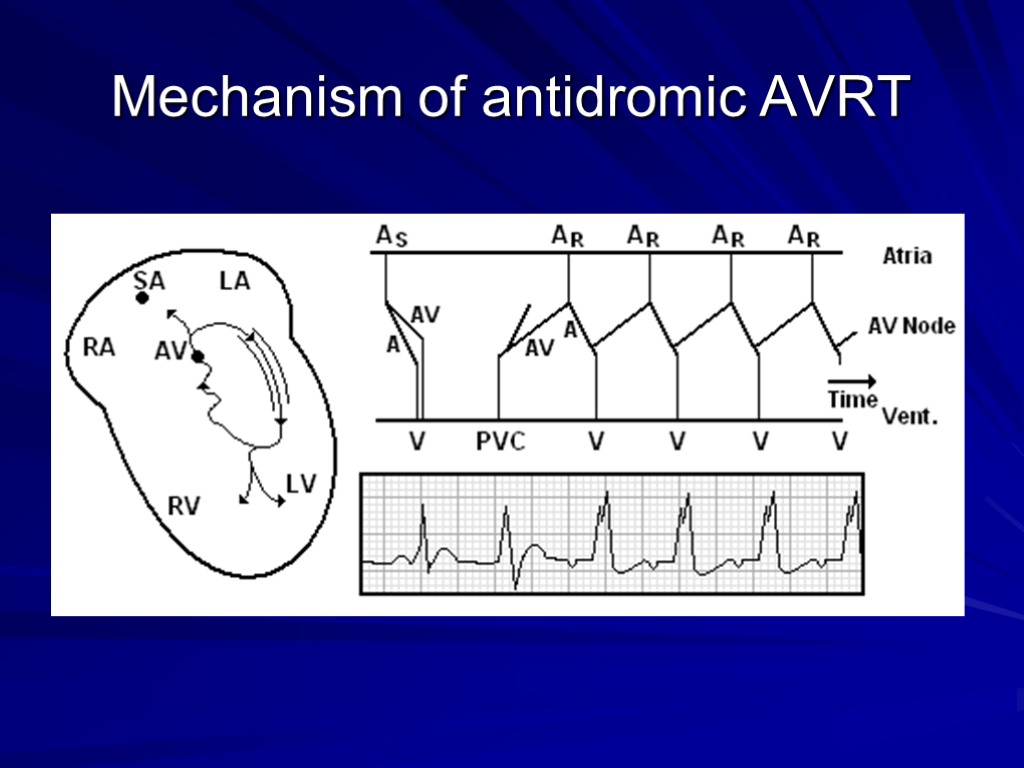 Mechanism of antidromic AVRT